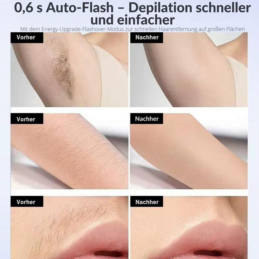Goldstern - IPL-Haarentferner - LumeaFrost